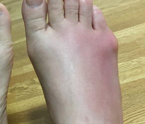 滑液包炎の足
